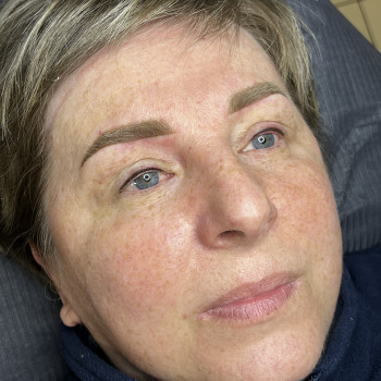 Перманент міжвійки та брів