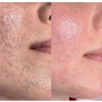 Пилинги Алмазный, химические, энзимные, механические и деликатные, Израиль
                    Косметолог Елена Одеса