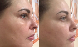 Масаж обличчя Косметолог Ольга Київ