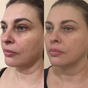 Масаж обличчя
                    Косметолог Ольга Київ