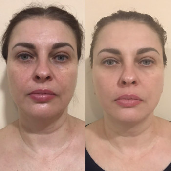 Масаж обличчя
                    Косметолог Ольга Київ