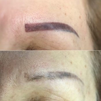 Видалення татуажу, фото - Майстер перманентного макіяжу Юлія Редюк