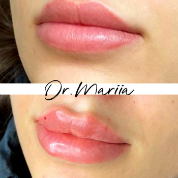 Увеличение губ, акция!
                    Косметолог Мария Киев