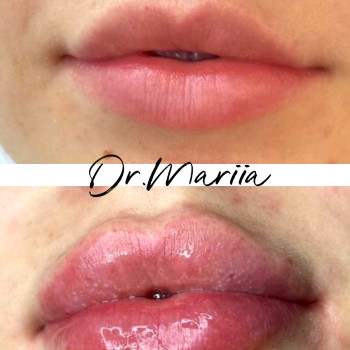 Увеличение губ, акция!
                    Косметолог Мария Киев