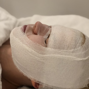 Бандажировання обличчя