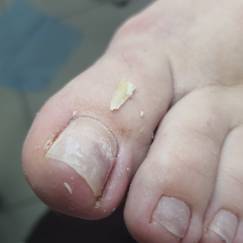 Врослий ніготь