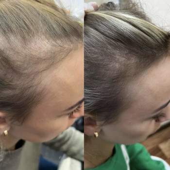 Мезотерапия волос
                    Косметолог Анна Харьков