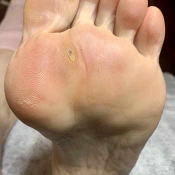 Подологія 
Стіржновий мозоль до