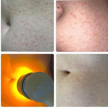 Лкування нейродерміту