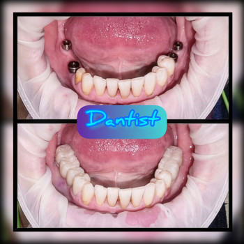 ІМПЛАНТАЦІЯ ЗУБІВ