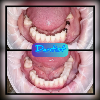 ІМПЛАНТАЦІЯ ЗУБІВ