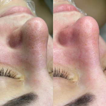 Чистая кожа -здоровая кожа ?