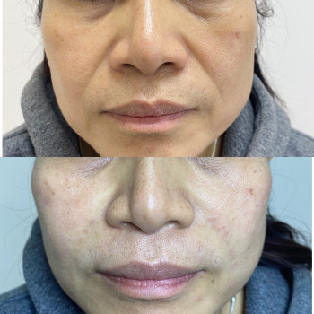 Возрастные заломы теперь не беда 
Всегда можно все исправит