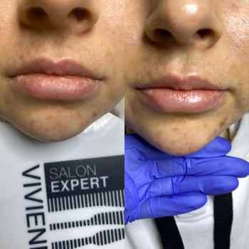 Удлинение подбородка добавляет желанный овал лица ?