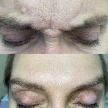 Работа ботулинотоксина