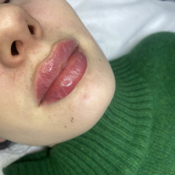 Исправление тяжелой формы и великолепные губы в итоге