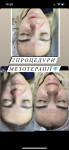 Мезотерапія обличчя Лікар-косметолог Христина Тернопіль