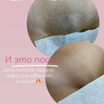 Лазерна епіляція