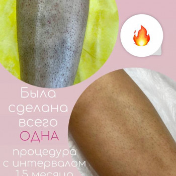 Лазерна епіляція