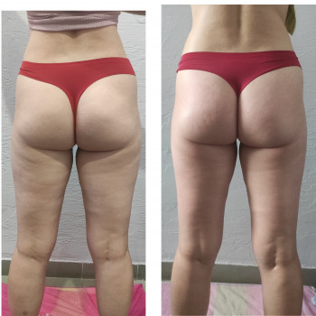 До/ після 5 сеансів масажу