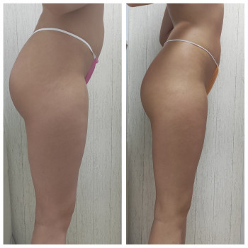 До / після 10 сеансів масажу