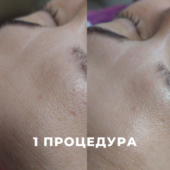 LPG масаж обличчя
                    Косметологічний центр My B-flexy Ірпінь