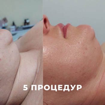 LPG масаж обличчя
                    Косметологічний центр My B-flexy Ірпінь