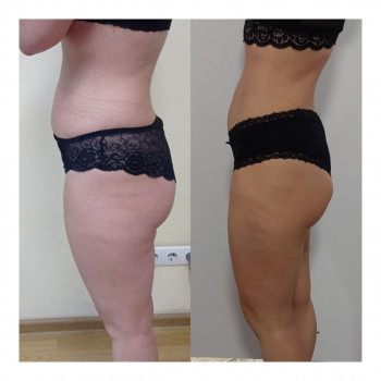 Пресотерапія
                    Косметологічний центр My B-flexy Ірпінь