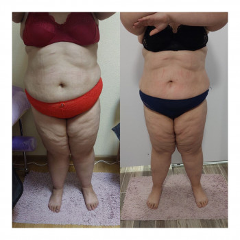 Пресотерапія
                    Косметологічний центр My B-flexy Ірпінь