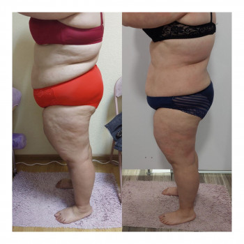 Пресотерапія
                    Косметологічний центр My B-flexy Ірпінь