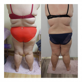 Пресотерапія
                    Косметологічний центр My B-flexy Ірпінь