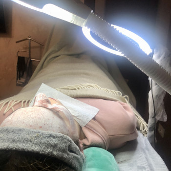 Чистка обличчя