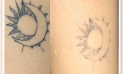 Видалення тату Косметолог Ирина Киев