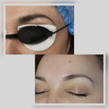 Видалення татуажу губ, брів
                    Косметолог Ирина Киев