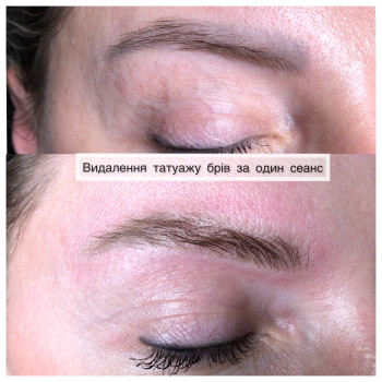 Видалення татуажу губ, брів
                    Косметолог Ирина Киев