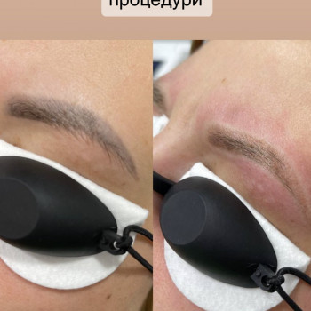 Видалення татуажу губ, брів
                    Косметолог Ирина Киев