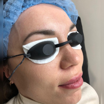 Видалення татуажу губ, брів
                    Косметолог Ирина Киев