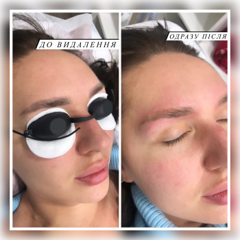 Видалення татуажу губ, брів
                    Косметолог Ирина Киев