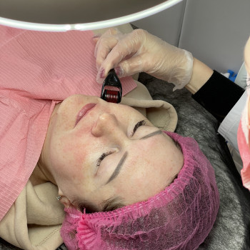 Мезороллер для лица: 
-выравнивается тон лица; 
-покр, фото - косметолог Відана Скрильнік