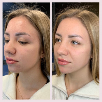 Кути Джолі, підборіддя, вилиці