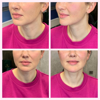 Носогубка, щічки, підборіддя, контур обличчя