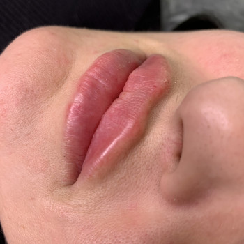 Первинні, 1 мл