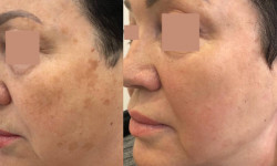 Шліфування шкіри СО2 Косметологический центр Ageless Esthetic Center Трускавец