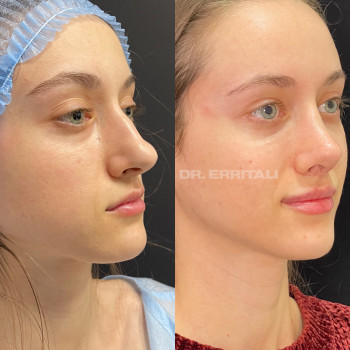 Ринопластика