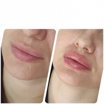 Контурная пластика лица
                    Косметолог-ін'єкціоніст Виктория Полтава