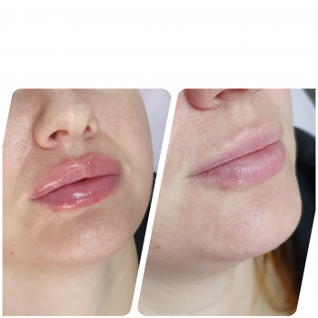 Контурная пластика лица
                    Косметолог-ін'єкціоніст Виктория Полтава