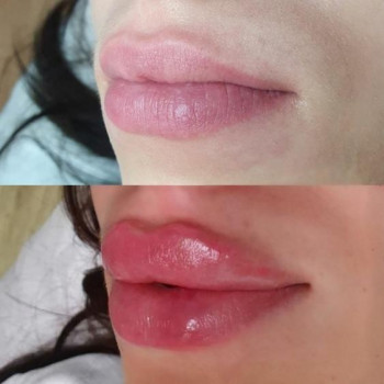 Контурная пластика лица
                    Косметолог-ін'єкціоніст Виктория Полтава