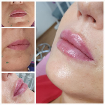 Контурная пластика лица
                    Косметолог-ін'єкціоніст Виктория Полтава