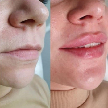 Контурная пластика лица
                    Косметолог-ін'єкціоніст Виктория Полтава