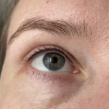 Загоєний перманент міжвійки через 4 місяці після процедури